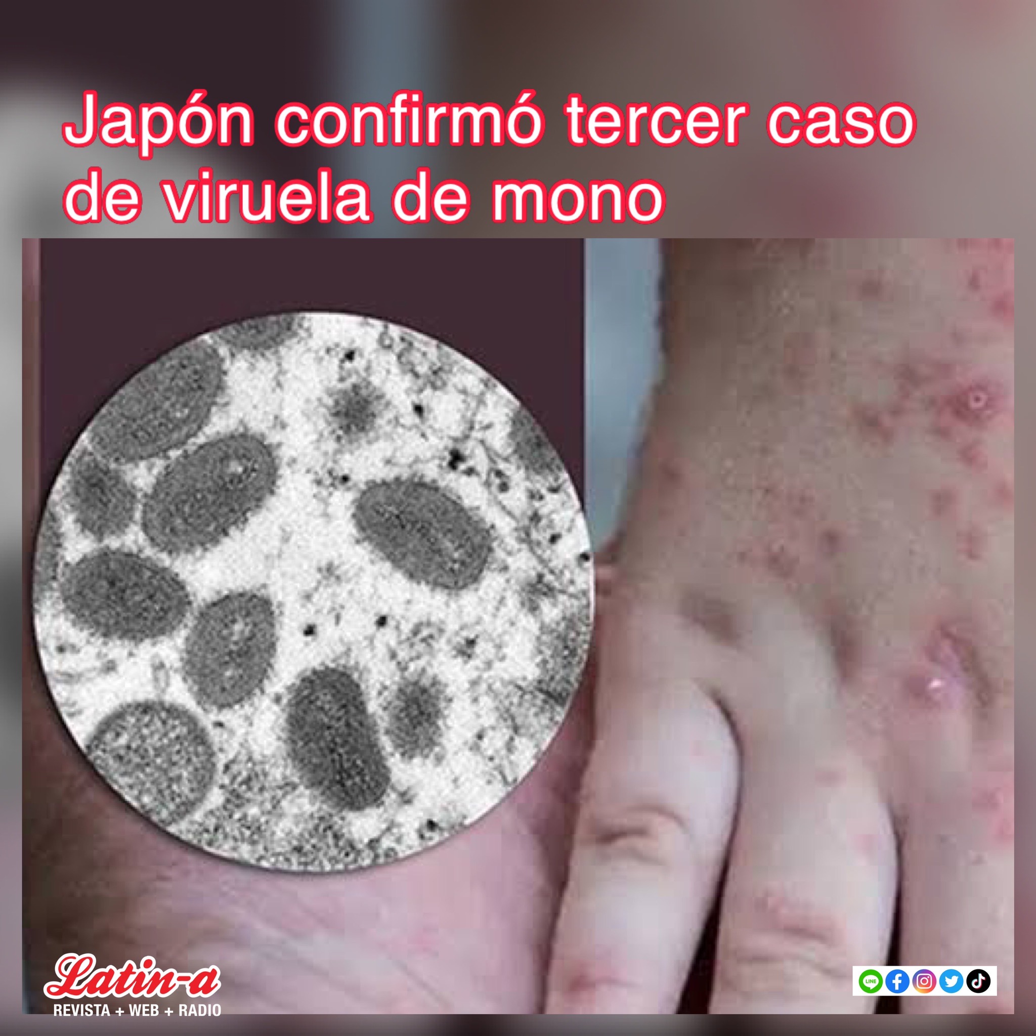 Confirman tercer caso de «Viruela de mono» en Japón.
