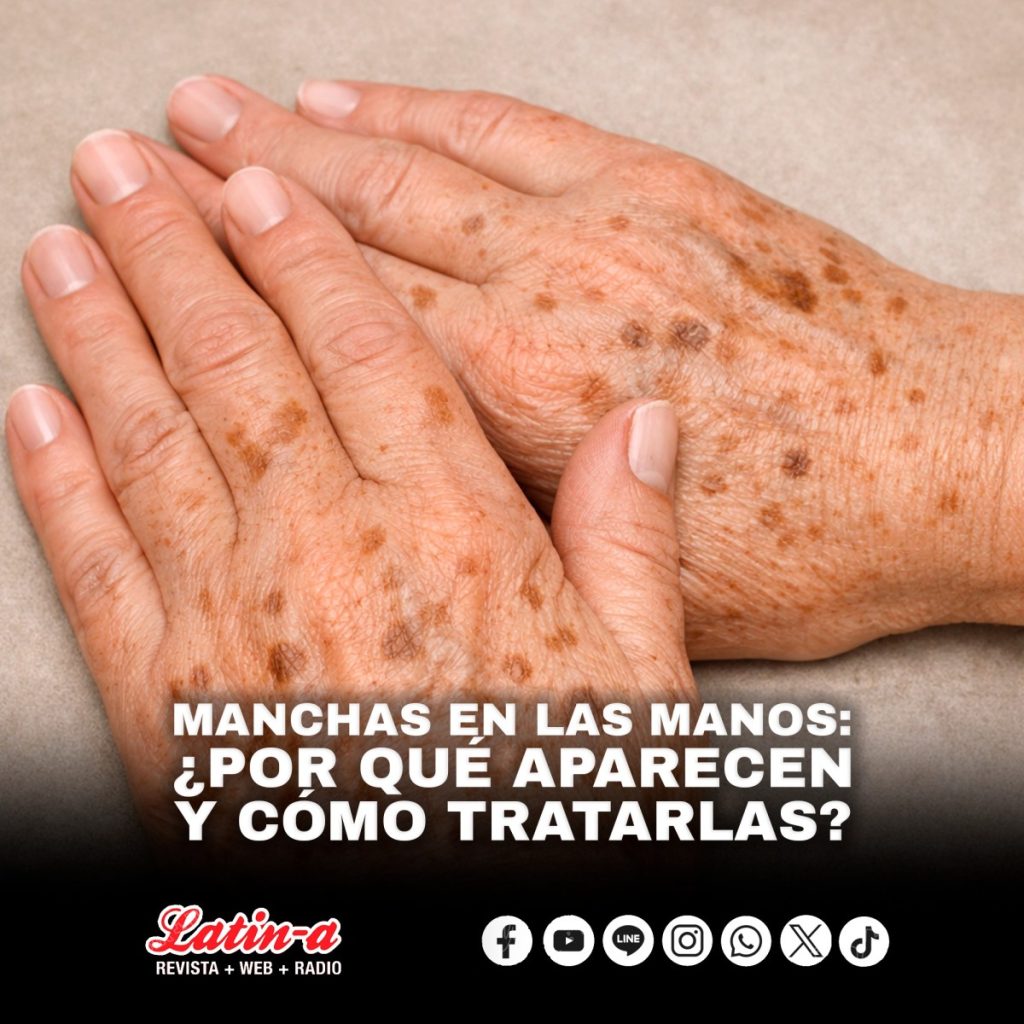 MANCHAS EN LAS MANOS: ¿POR QUÉ APARECEN Y CÓMO TRATARLAS?