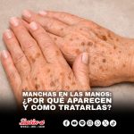 MANCHAS EN LAS MANOS: ¿POR QUÉ APARECEN Y CÓMO TRATARLAS?
