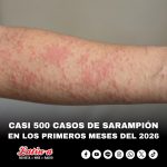 CASI 500 CASOS DE SARAMPIÓN EN JAPÓN EN LOS PRIMEROS MESES DEL 2026